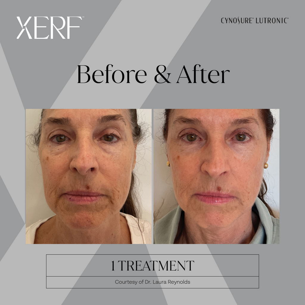 Picture of ZERF Structural Skin Tightening Before After Riverside CA