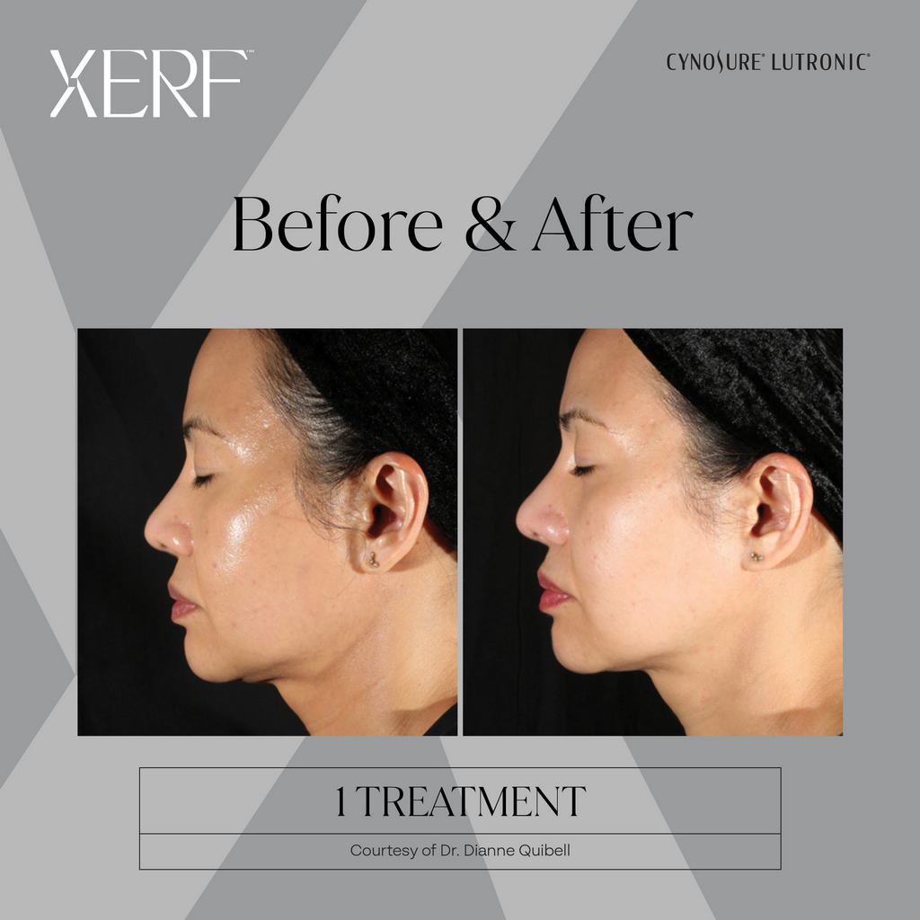 XERF Before After Riverside CA